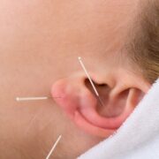 Close-up of acupuncture needles on an ear. Close-up of three acupuncture needles on the ear of a woman